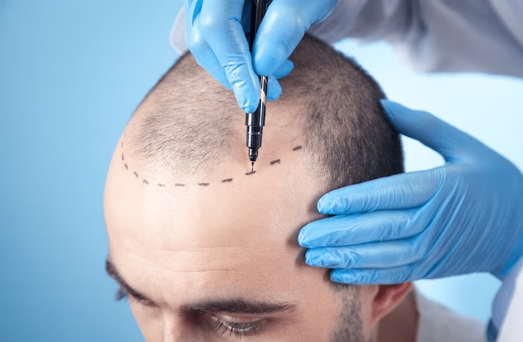 انواع روش‌ های کاشت مو طبیعی سر