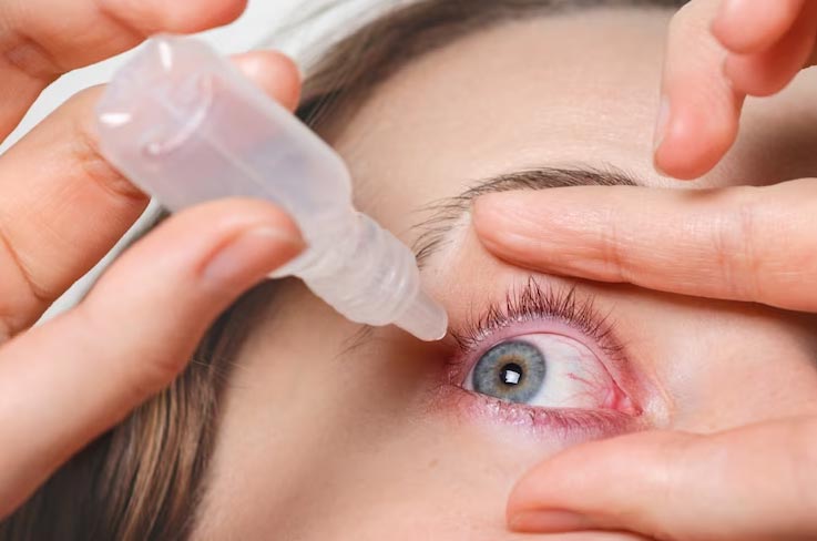راهکارهایی برای کاهش قرمزی و التهاب پس از کاشت مژه چشم 