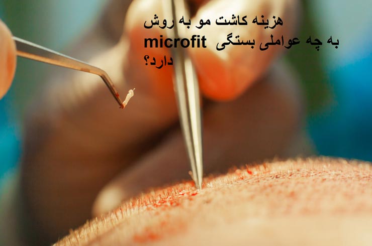 هزینه کاشت مو به روش microfit به چه عواملی بستگی دارد