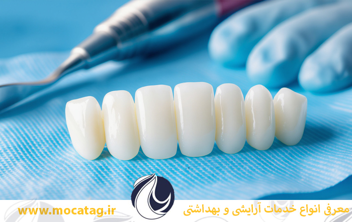 تفاوت لمینت و کامپوزیت و بلیچینگ دندان راهنمایی جامع همه چیز درباره لمینت دندان