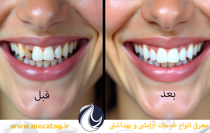 تفاوت لمینت و کامپوزیت و بلیچینگ دندان راهنمایی جامع کامپوزیت دندان چیست